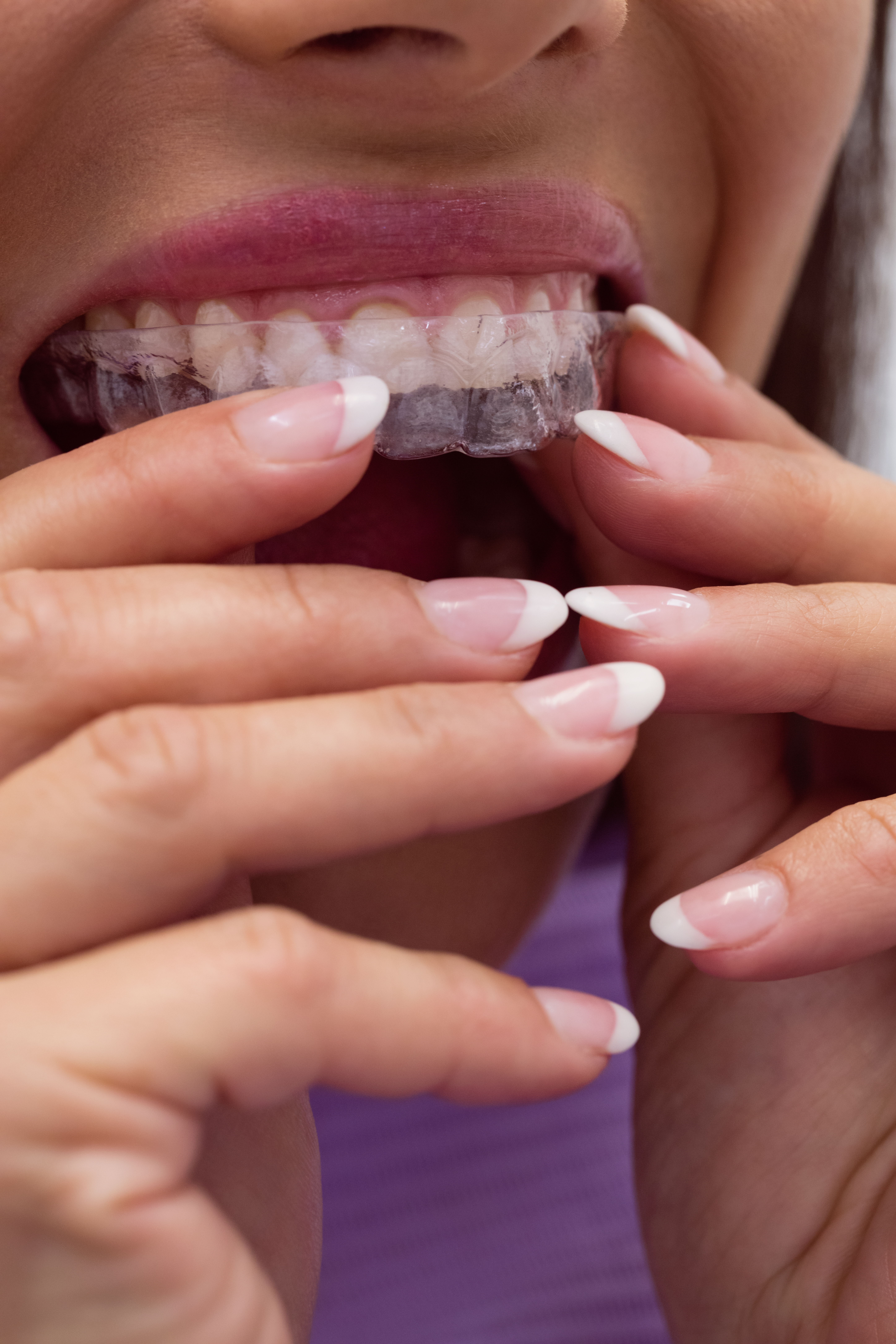 Mouthguards in Naperville, IL