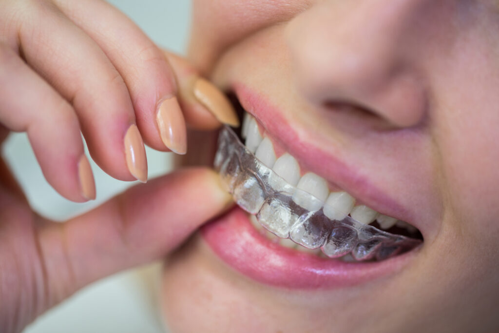 Invisalign Naperville IL